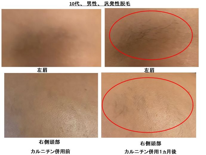 円形脱毛症　病院